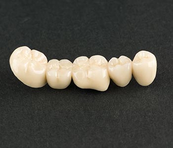 best Dental Crowns near Waterloo ON provides Crowns and Bridges