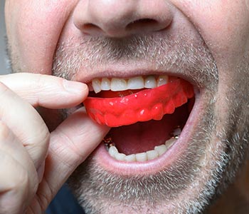 Dental Mouth Guards in Waterloo ON A man wearing mouth guard
