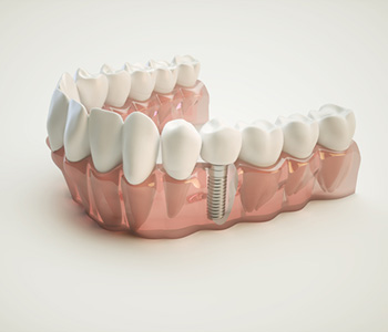 Replace Missing Tooth in Waterloo area