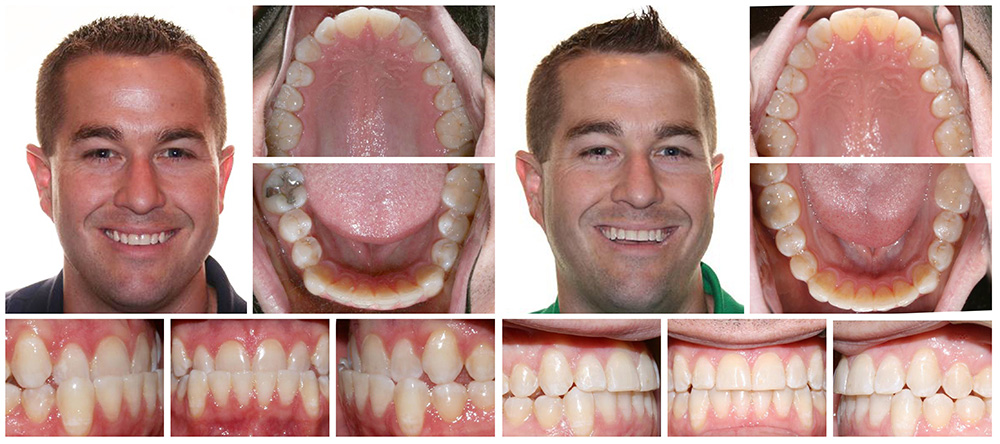 Invisalign® Before and After Results