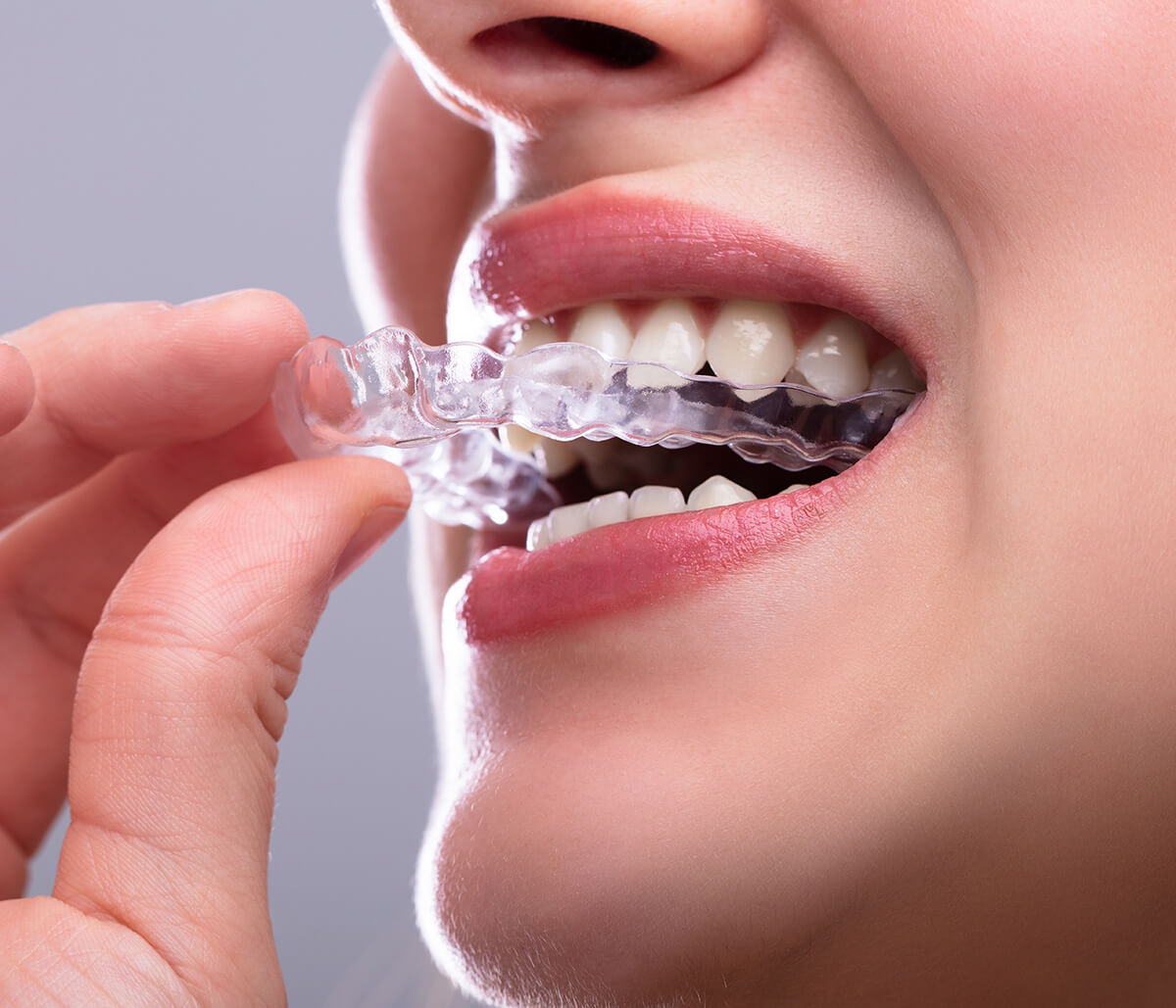 Invisalign Teeth Straightening at Auburn Centre Dental in Waterloo Area