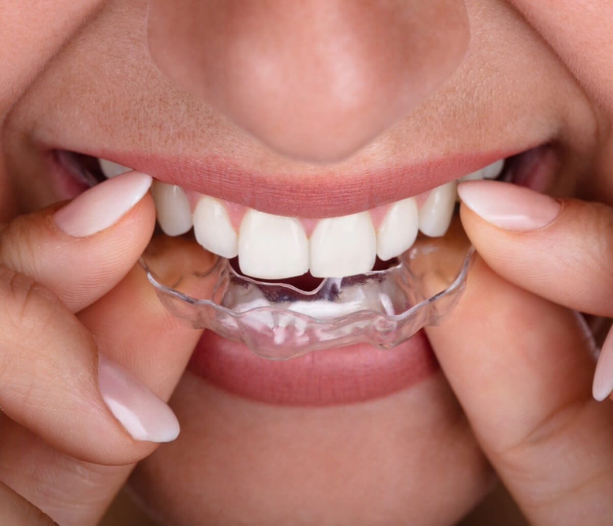 Invisalign for Teeth Straightening in Waterloo ON area