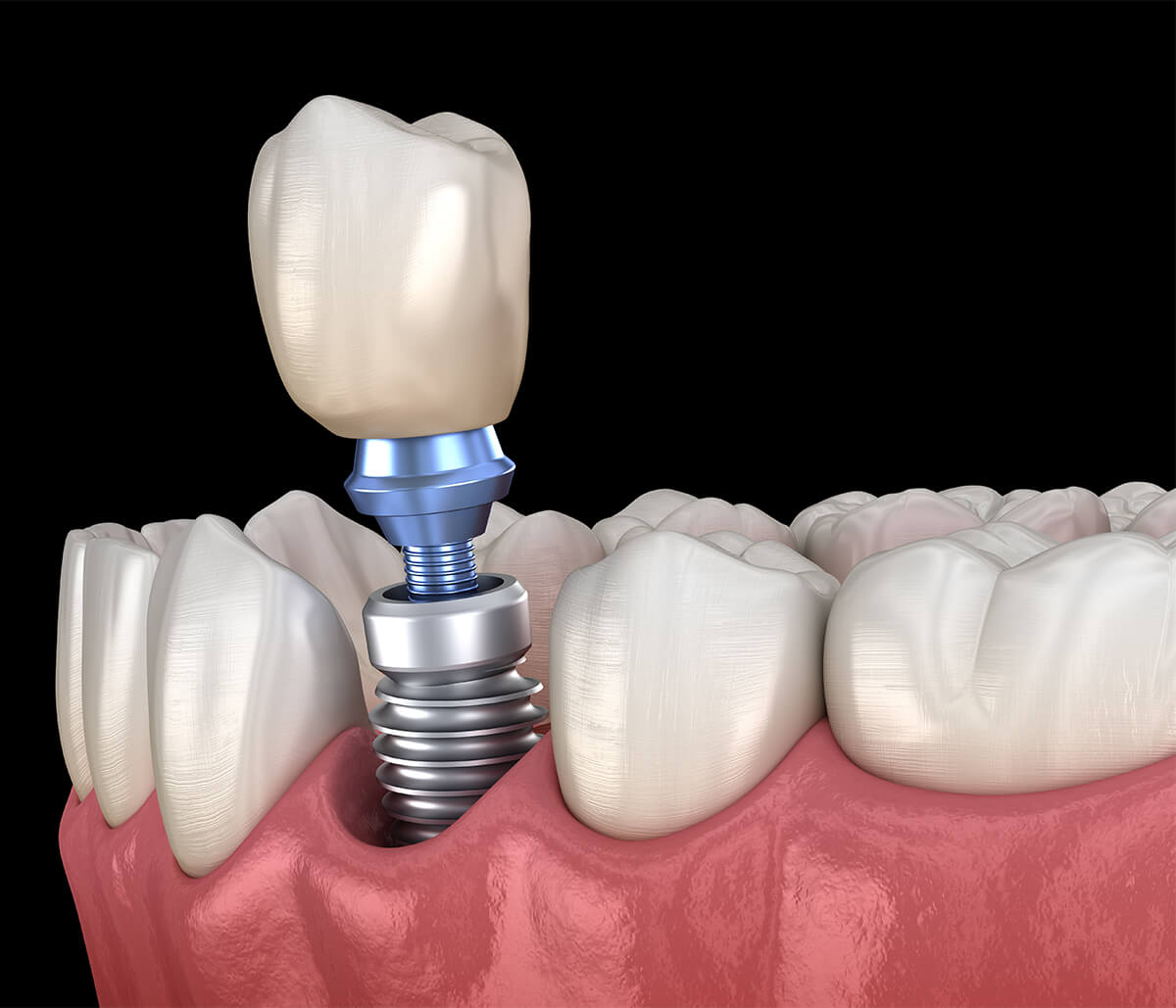 Replacing Missing Teeth in Waterloo ON Area