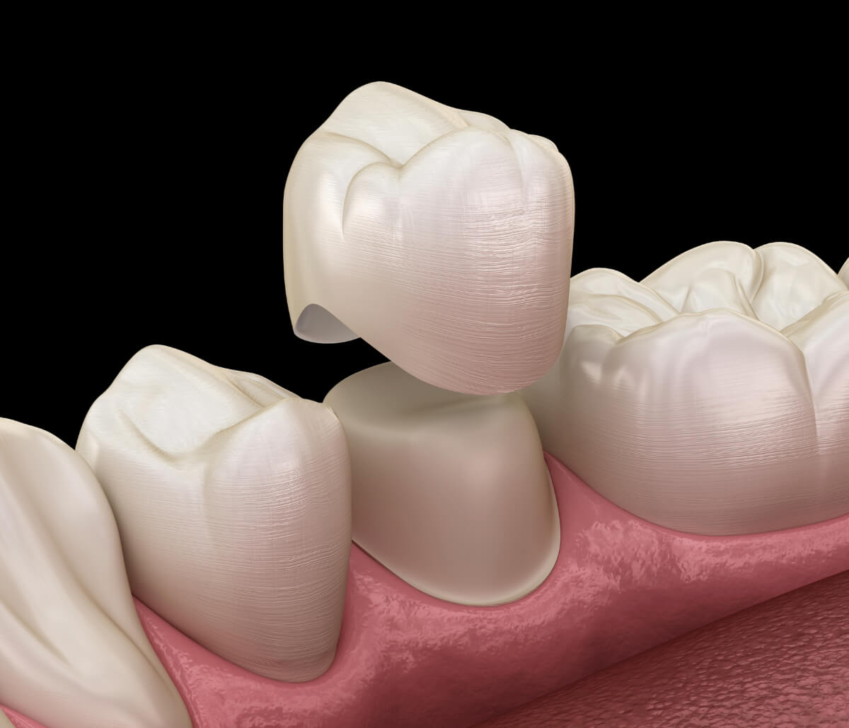 Dental Crowns for Cracked Teeth in Waterloo area