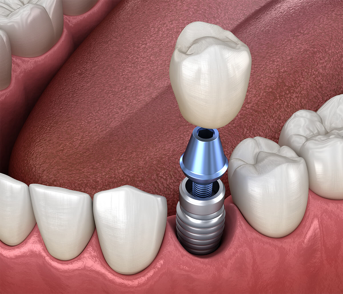 Replace Missing Tooth in Waterloo ON Area