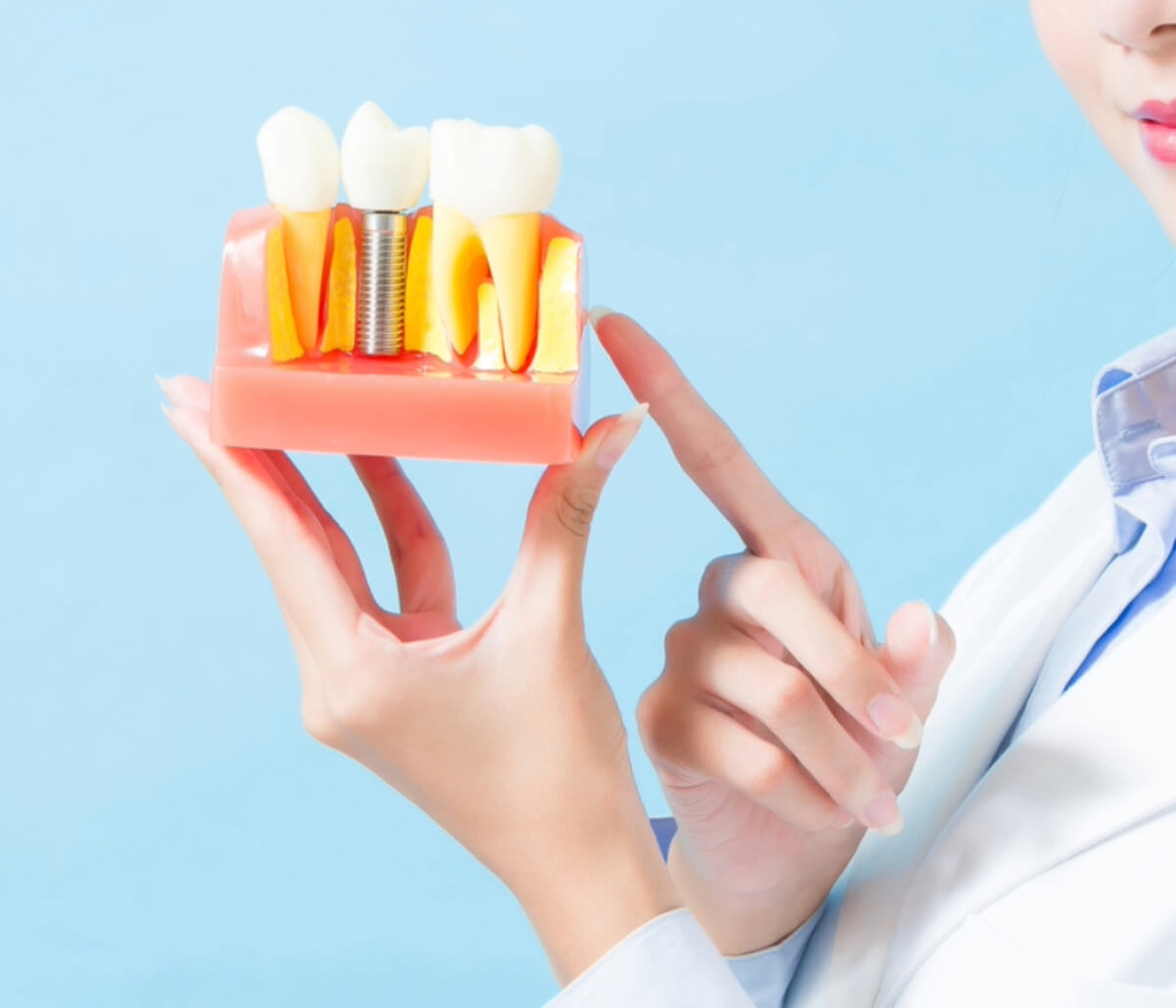 Dental Implants in Waterloo ON area